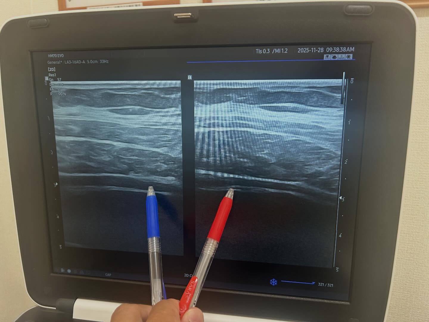 下関市内の、みよし鍼灸整骨院内で腰痛評価の際に撮影されたエコー写真です